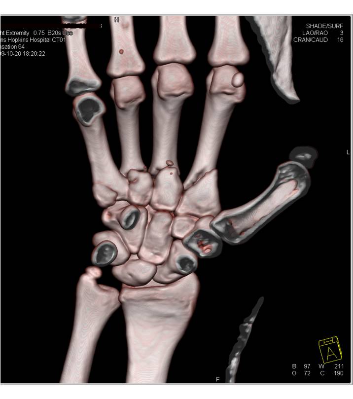 Image result for 3 d ct of a hand fracture