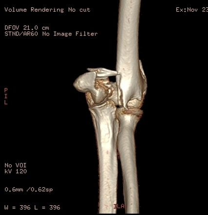 Image result for 3 d ct scan of a distal humerus fracture