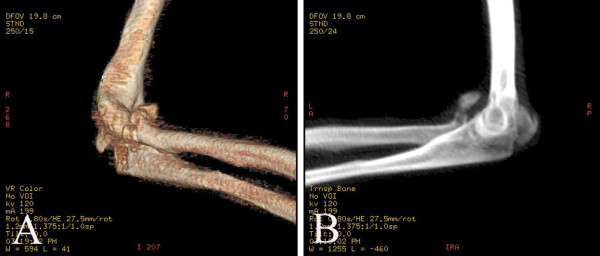 Image result for 3d ct of olecranon fracture