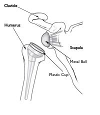 Image result for diagram of a reverse shoulder replacement