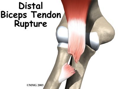 Image result for diagram of bicep muscle tear at elbow