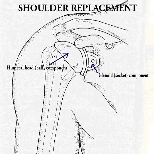 Image result for drawing for total shoulder replacement components