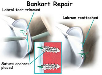 Image result for image for bankart repair