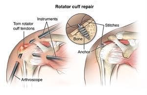 Image result for image for rotator cuff repair