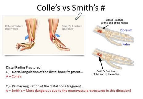 Image result for image of Colles fracture