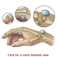 Image result for image of ganglion cyst