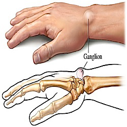 Image result for image of ganglion cyst