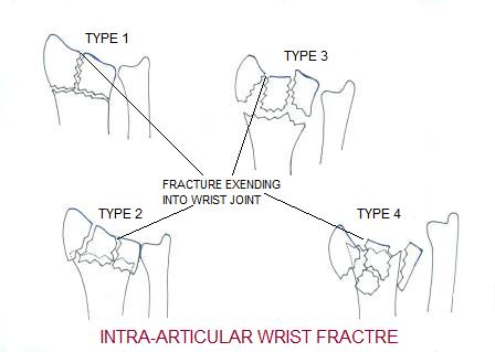 Image result for image of intra articular wrist fracture