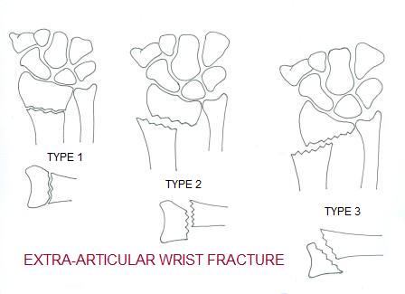 Image result for image of intra articular wrist fracture