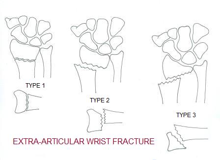 Image result for image of intra articular wrist fracture