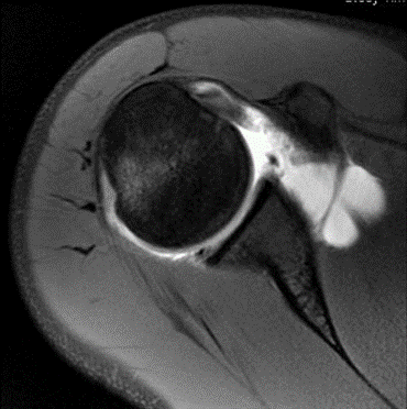 Image result for image of MRI for shoulder instability