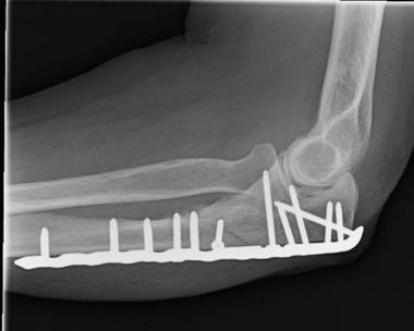 Image result for image of olecranon fracture treated with plates screws