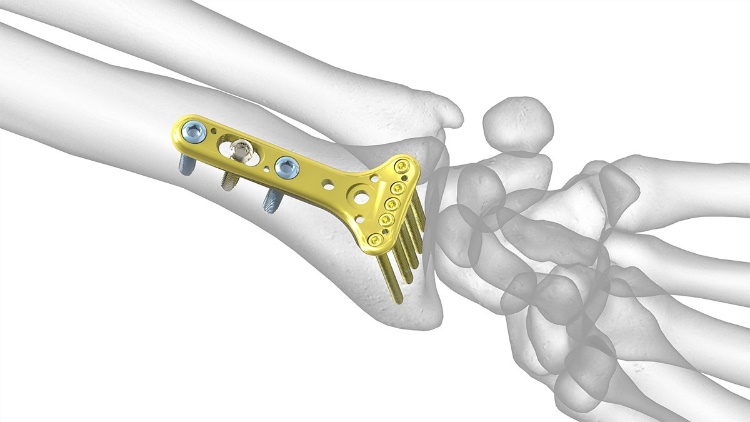 Image result for image of plates and screws for distal radius fracture