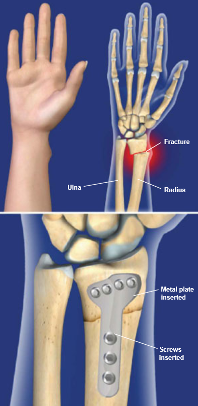 Image result for image of plates and screws for distal radius fracture