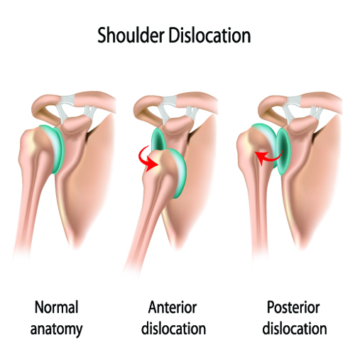 Image result for image of shoulder dislocation