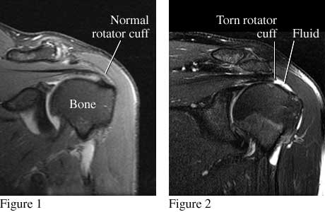 Image result for mri of a rotator cuff tear