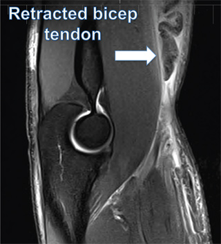 Image result for mri of distal biceps tendon rupture