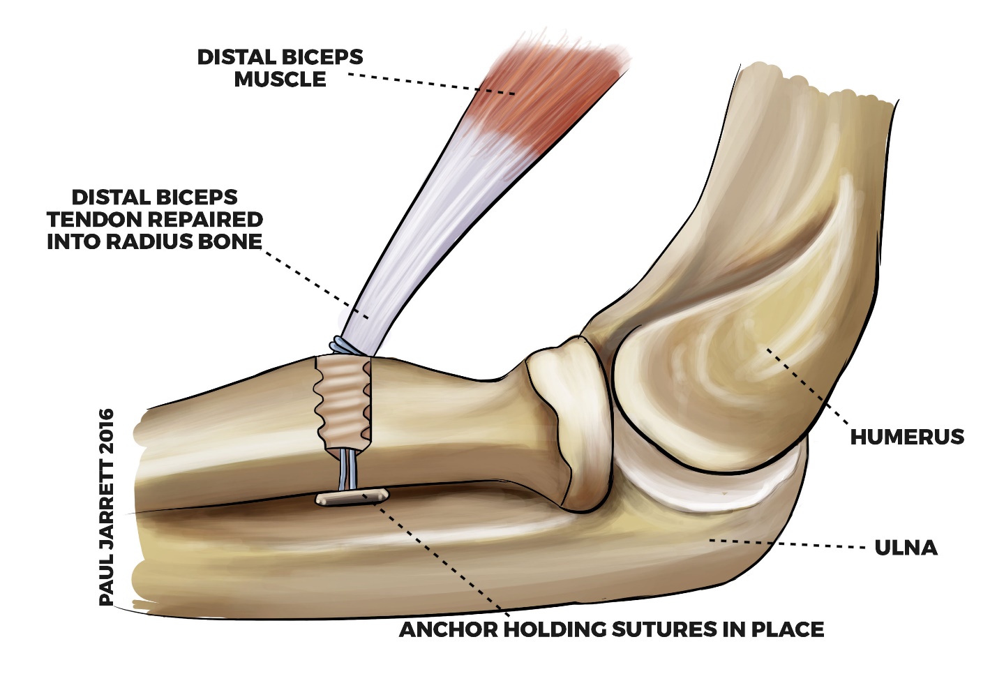 Ripped Bicep Tendon