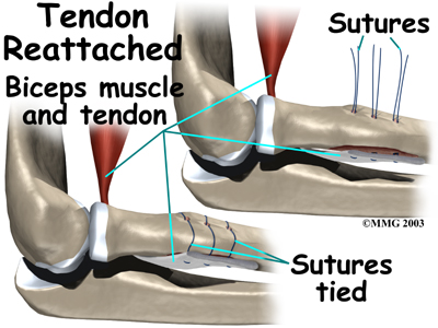 Image result for picture of distal bicep tear