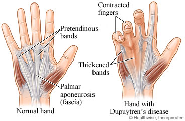 Image result for picture of dupuytren's contracture