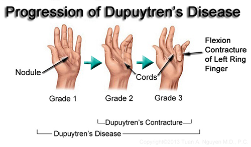 Image result for picture of dupuytren's contracture