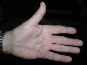 Image result for picture of healed dupuytren excision