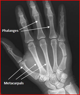Image result for x ray of metacarpal fracture
