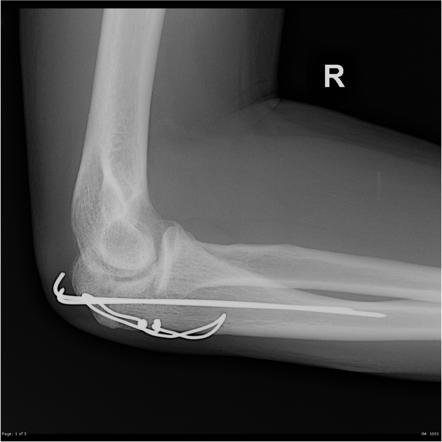 Image result for x ray of olecranon fracture