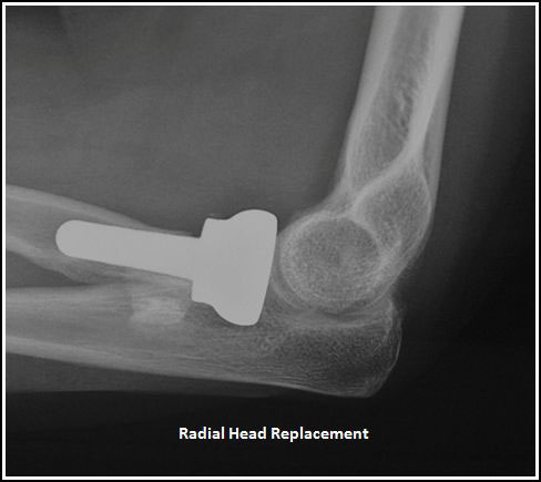Image result for x ray of radial head fracture treated with screws