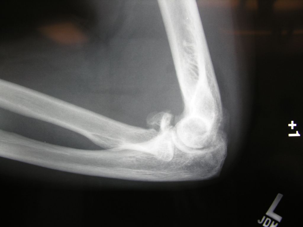 Image result for x ray of radial head fracture
