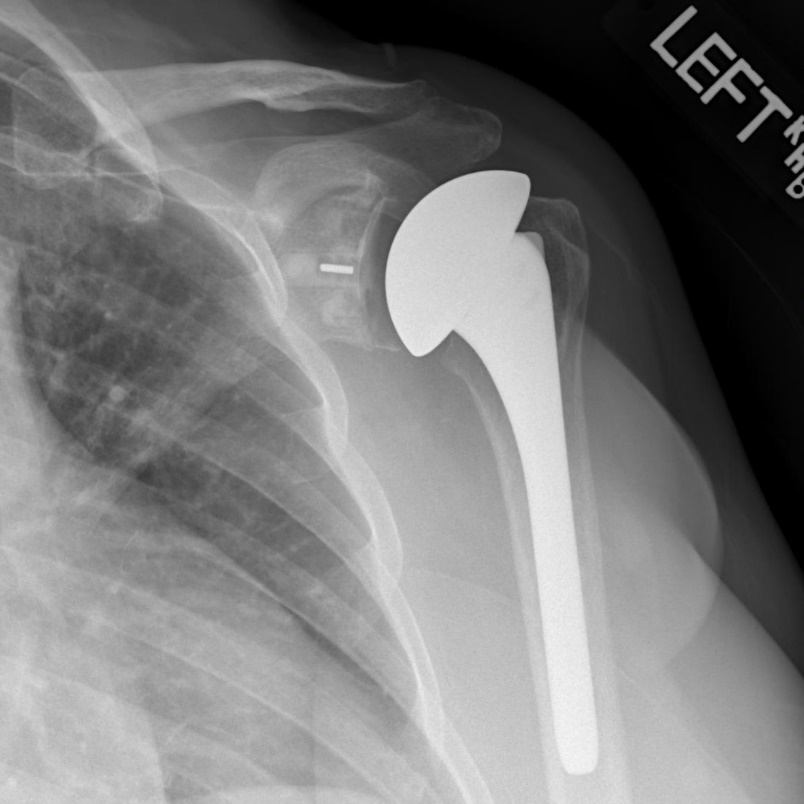 Image result for x ray of shoulder replacement