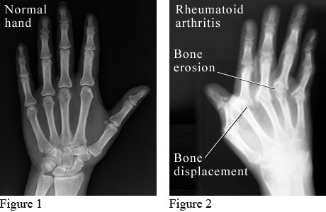 Image result for xray of arthritis of hand