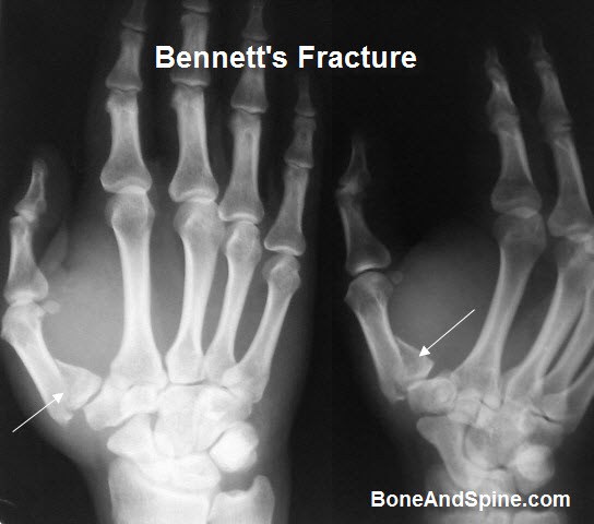 Image result for xray of articular fracture of hand