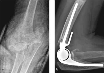 Image result for xray of distal humerus fracture