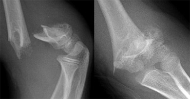 Image result for xray of distal humerus fracture