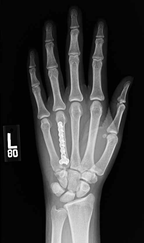 Image result for xray of hand fracture treated with pins