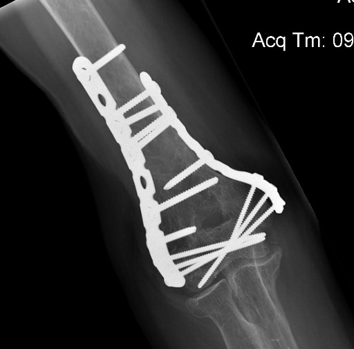Image result for xray of orif of distal humerus