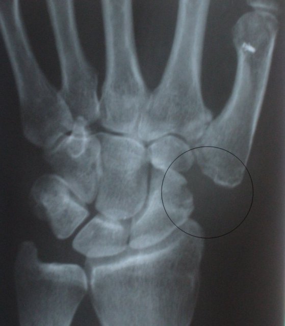 Image result for xray of thumb replacement