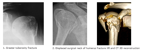 Image result for 3 d ct of proximal humerus fracture image
