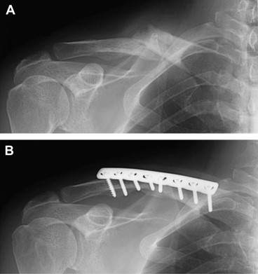 Image result for image of a orif clavicle