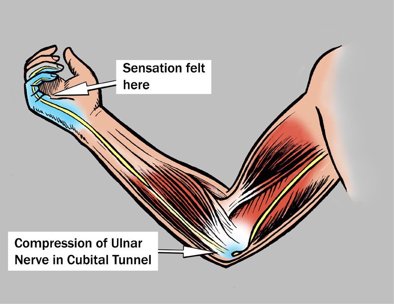 Ulnar Nerve Entrapment at the Elbow - Dr. Groh