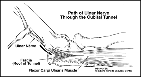 Ulnar Nerve Entrapment: What Is It, Symptoms, Causes, Treatment