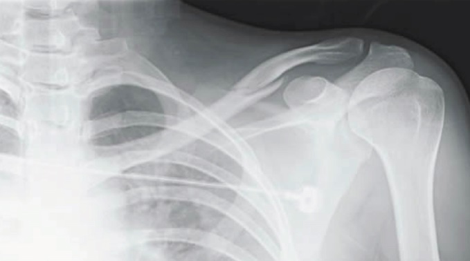 Image result for image of minimally displaced clavicle fracture