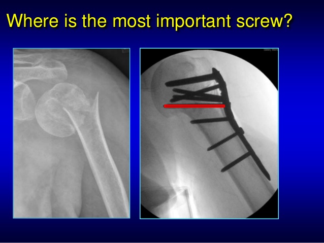Image result for image of proximal humerus fracture treated with orif