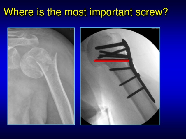 proximal humerus fracture presentation