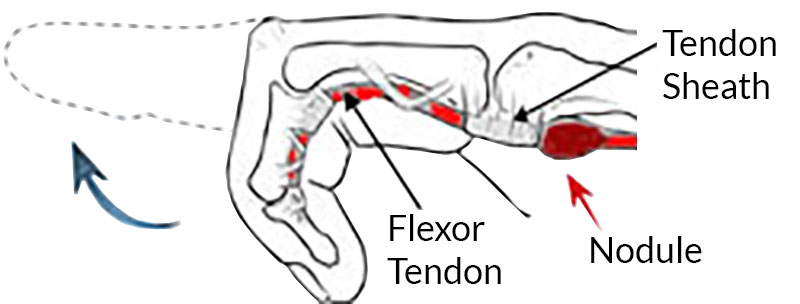 Image result for image of the flexor sheath of fingers