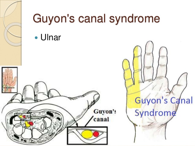 Image result for images guyon's canal syndrome