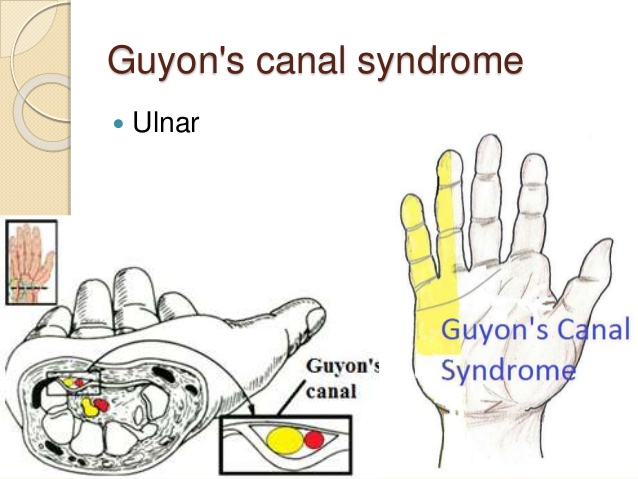 ulnar tunnel syndrome