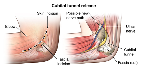 Image result for images of tunnel at the cubital tunnel