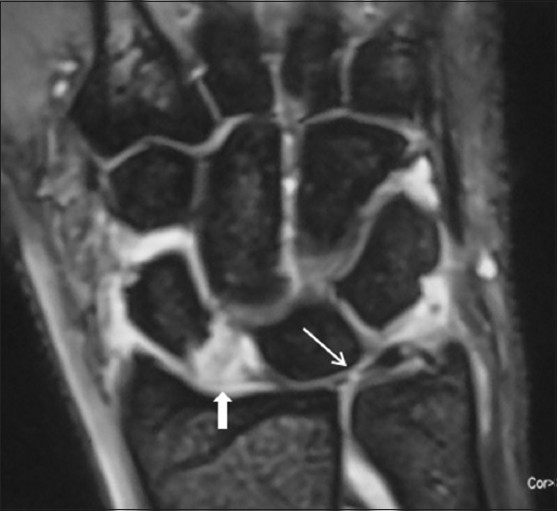 Image result for mri of intrinsic ligament tear